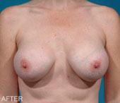 Patient # 91247 After Photo # 2